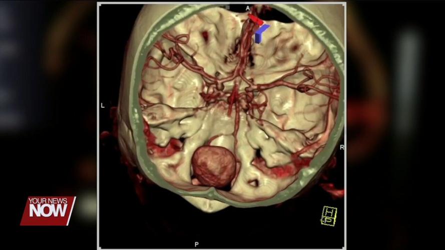 Mother survives large brain aneurysm while pregnant