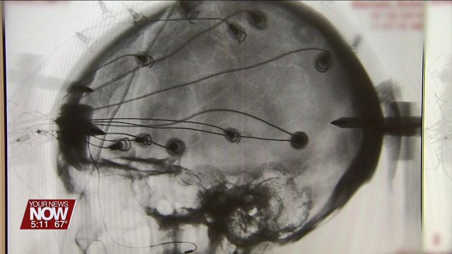 Cleveland Clinic study explores deep brain stimulation for stroke patients