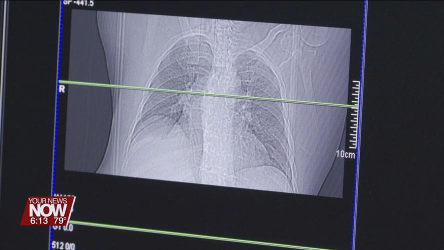 Recognizing the importance of lung cancer screenings in honor of World Lung Cancer Day