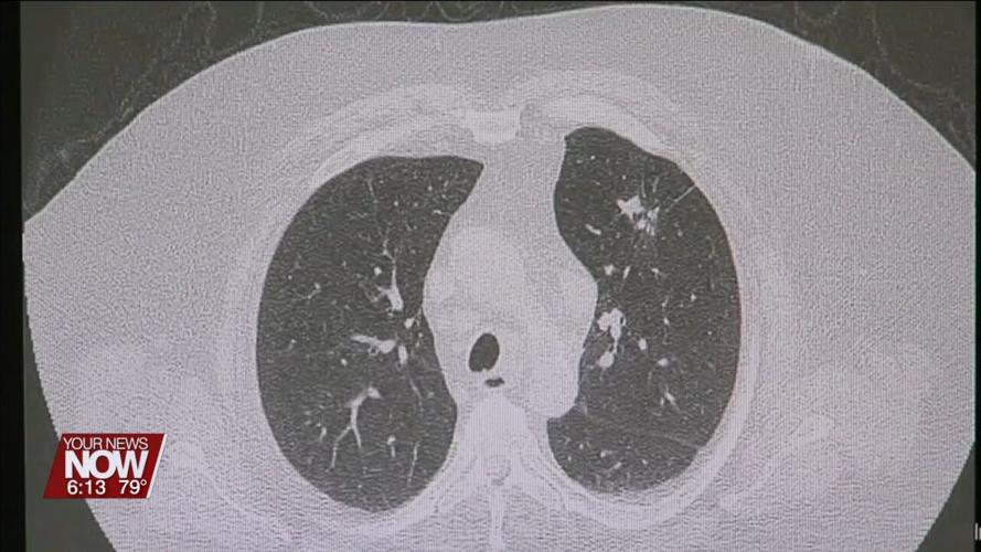 Recognizing the importance of lung cancer screenings in honor of World Lung Cancer Day