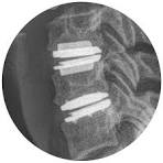 Motion-Preserving Disc Replacement