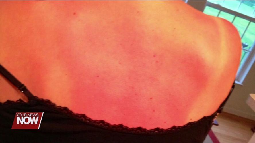 Doctor raises awareness of the dangers of sun overexposure as Memorial Day approaches