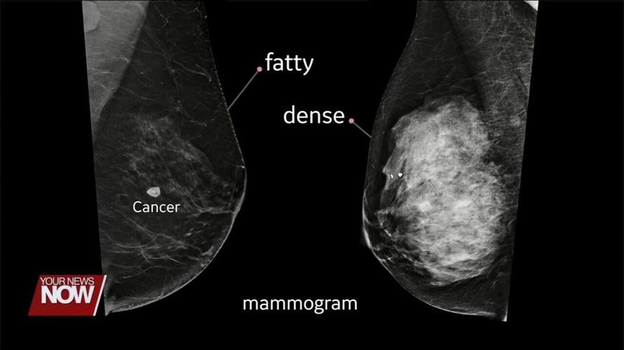 Recommended age to start breast cancer screenings has dropped and doctors see this as a good move