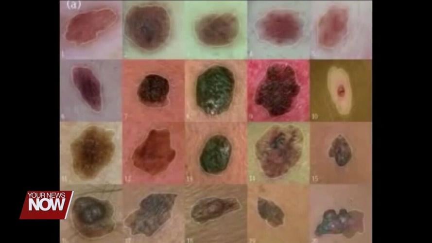 Gray Dermatology and Lima Memorial teaming up for free skin cancer screening on June 1st