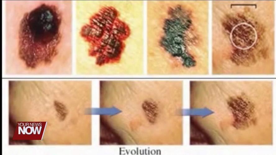 Gray Dermatology and Lima Memorial teaming up for free skin cancer screening on June 1st