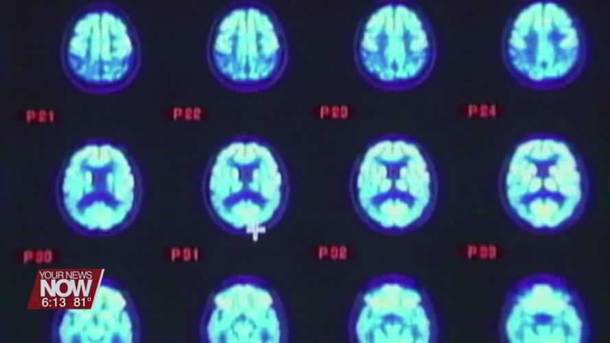 Doctors want you to know the signs of a stroke