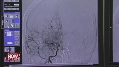 Doctors want you to know the signs of a stroke