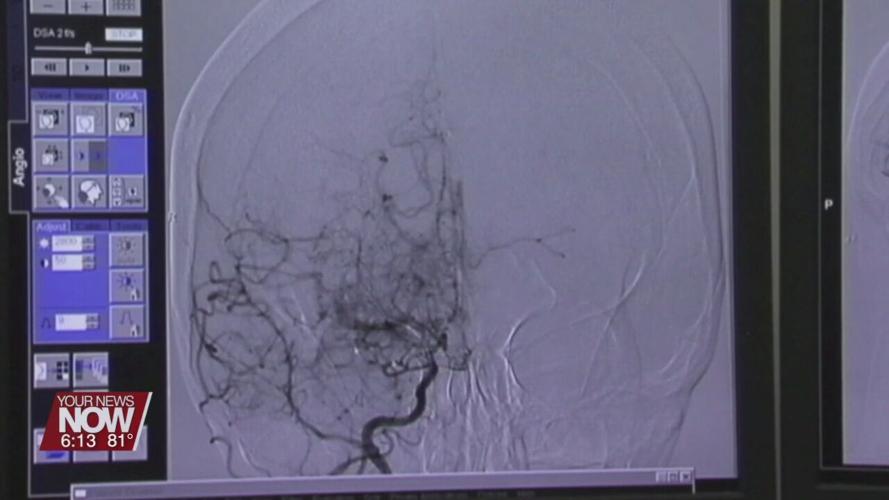 Doctors want you to know the signs of a stroke