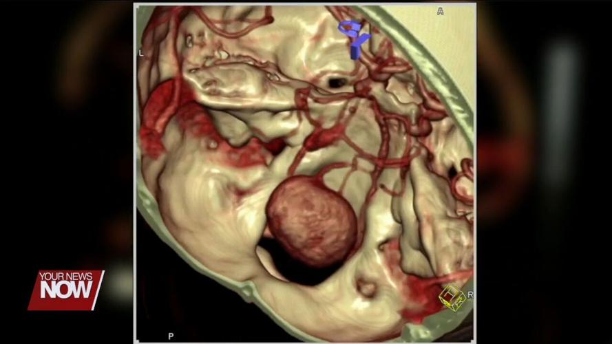 A mother discusses her journey of having a large brain aneurysm removed while pregnant