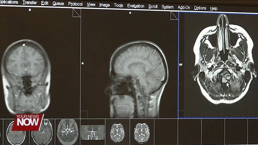 A mother discusses her journey of having a large brain aneurysm removed while pregnant