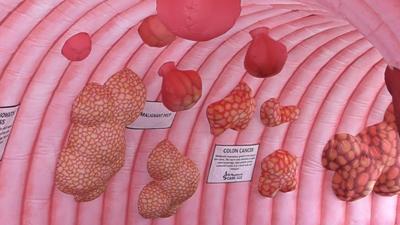 GI Physicians highlights the importance of Colonoscopies during Colorectal Cancer Awareness Month
