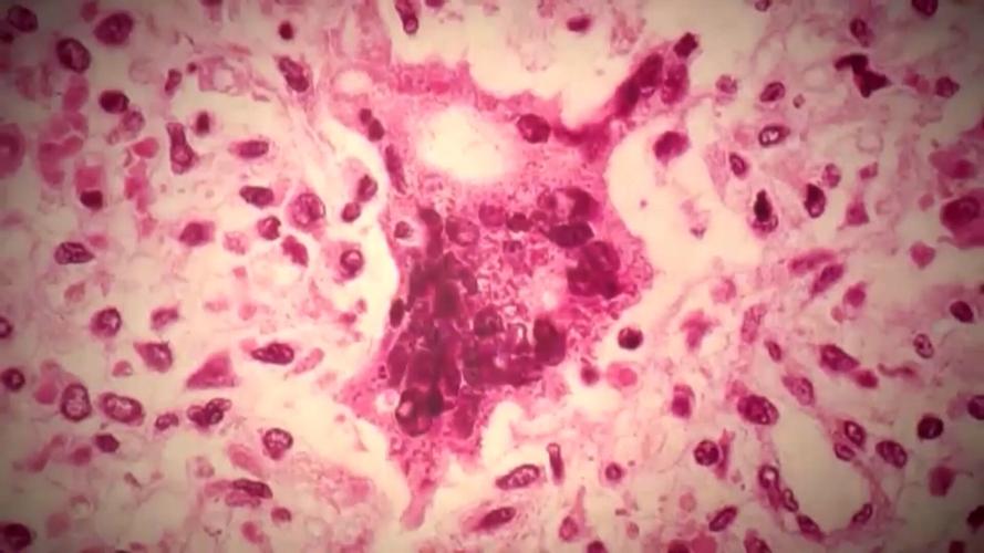 Allen County Public Health reports no new measles cases after first case confirmed & stresses importance of MMR vaccine