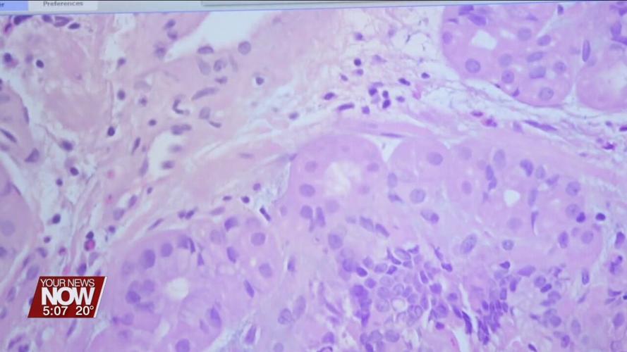 AI tools see beyond the human eye to better diagnose cancer