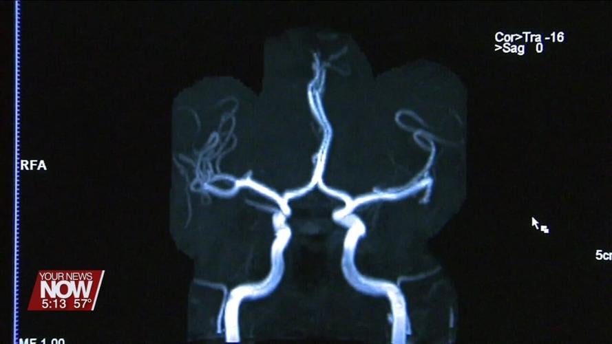 Researchers make new discovery that could help diagnose CTE brain