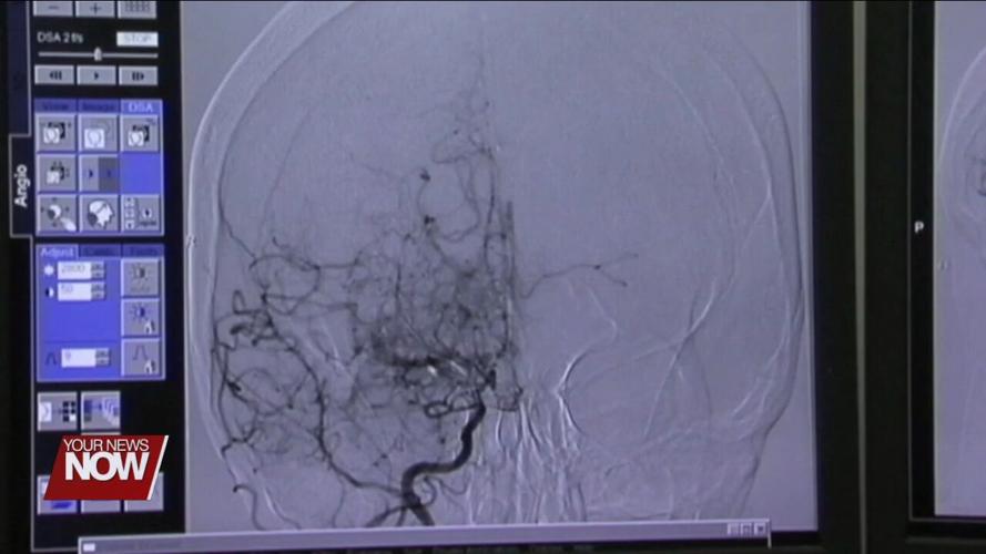 Stroke Awareness Month Remember BE FAST when spotting a stroke