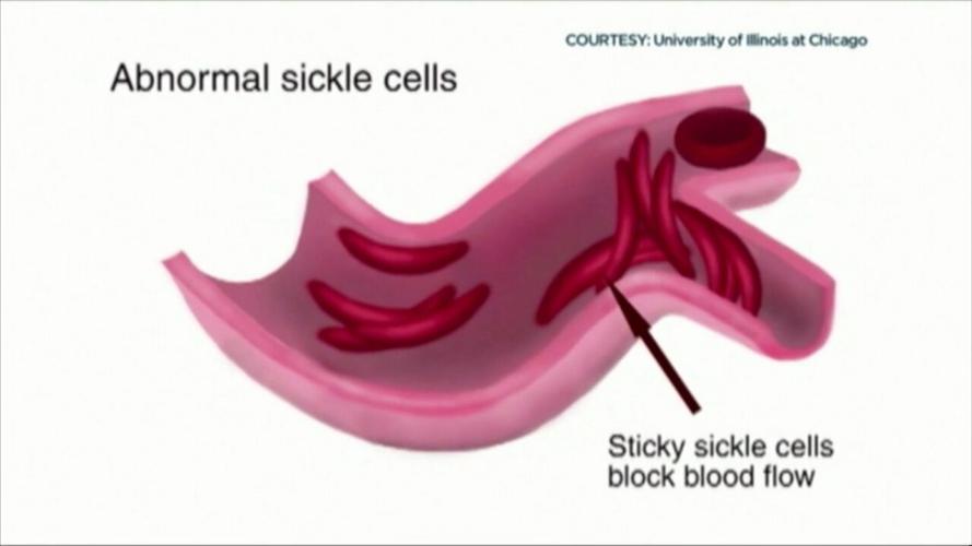 Forum raises awareness to Sickle Cell Disease