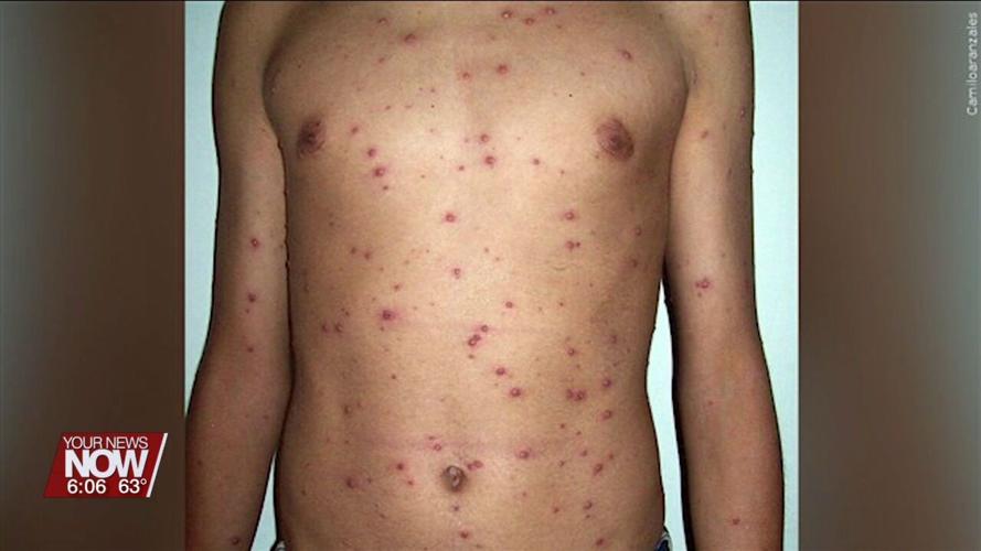 Health officials report clusters of chickenpox outbreaks around Ohio