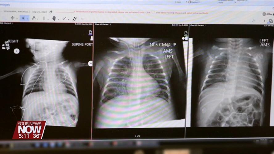 Ohio mother reflects on her baby's severe complications with RSV