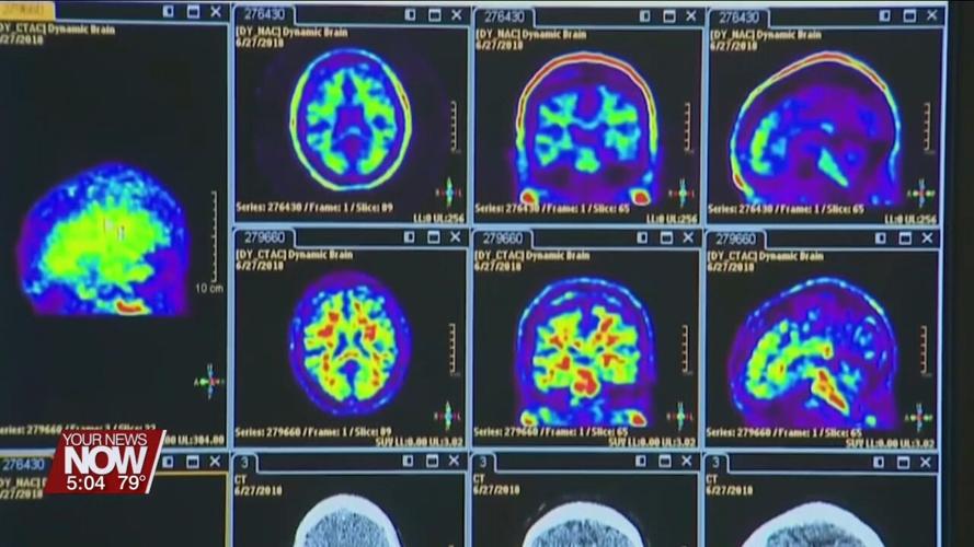 Allen County among top 8 for Alzheimer's prevalence in Ohio