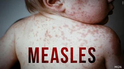 Measles Generic
