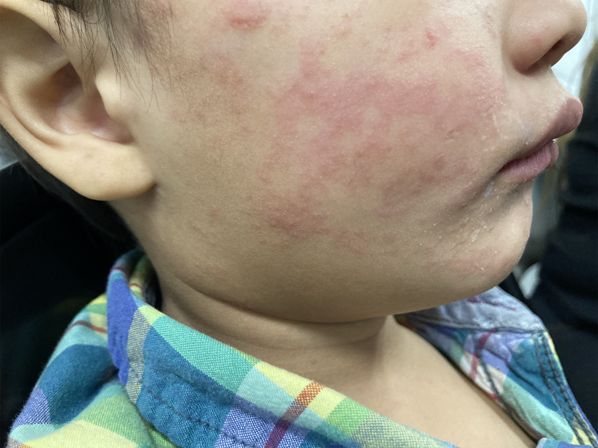 Measles