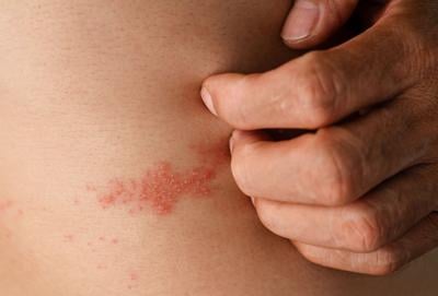 Shingles