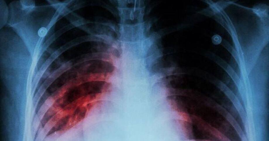 Case of tuberculosis confirmed at middle school in Hickory - Vimarsana News