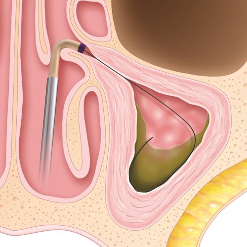 Sinus procedure