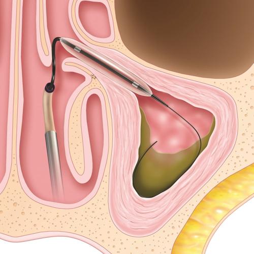 Sinus procedure