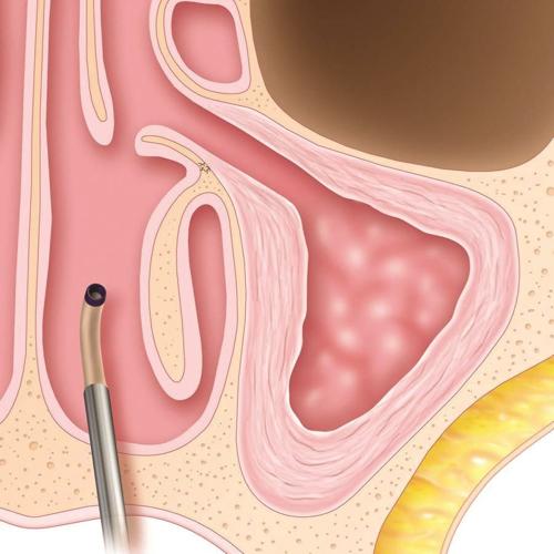 Sinus Procedure