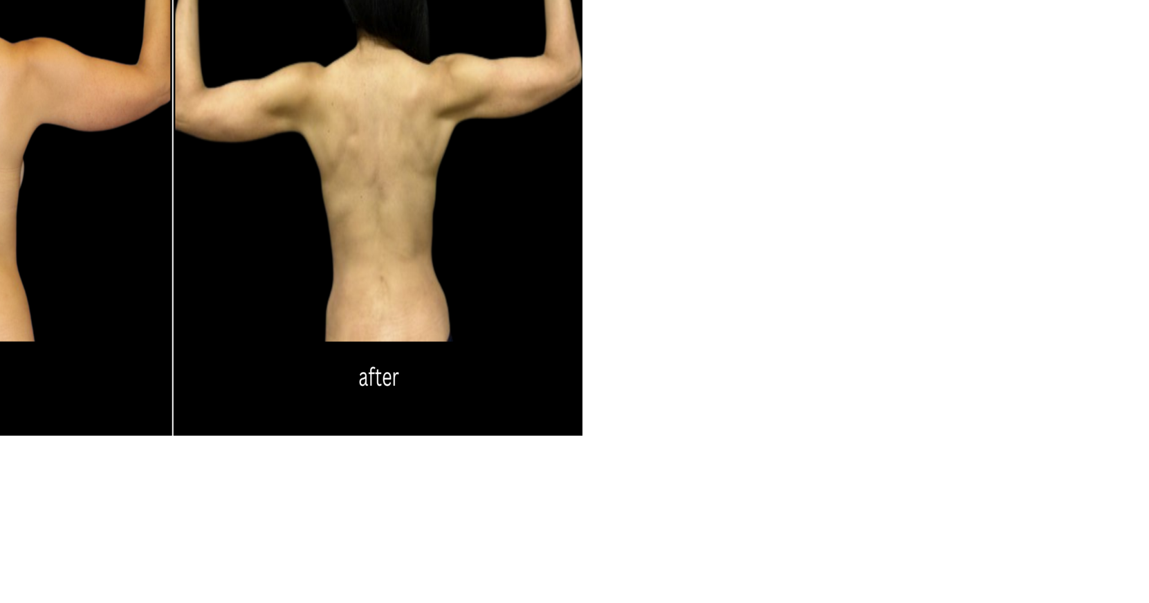 Several treatment options available to contour your arms | Health ...