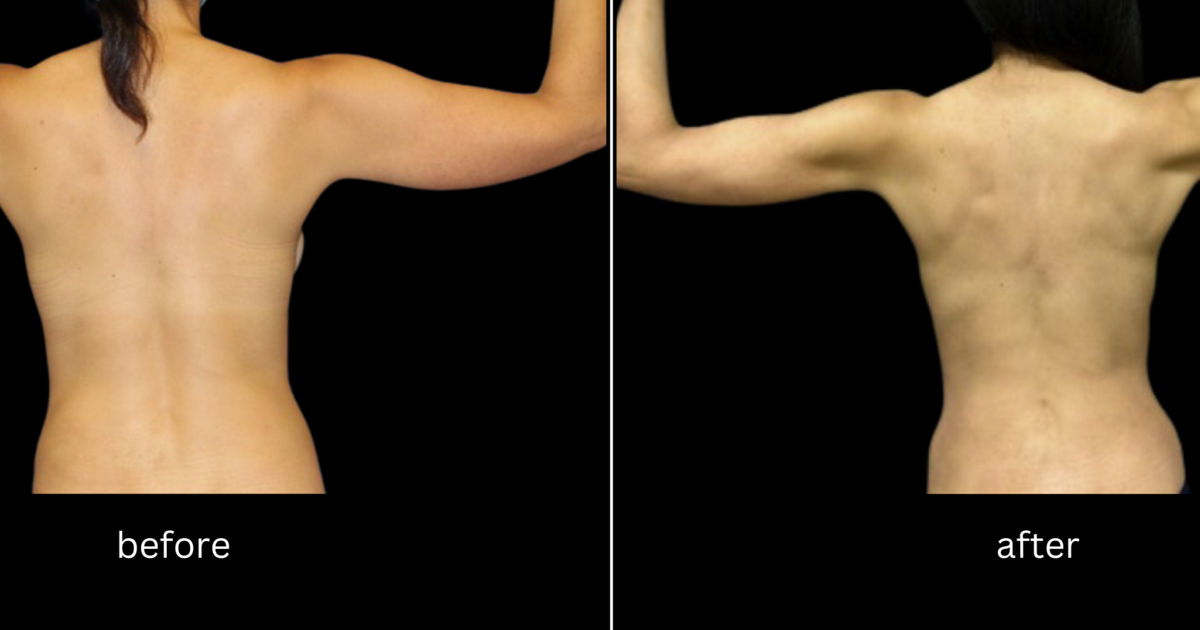 Contorted Arm Several treatment options available to contour your arms | Health ...