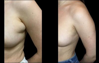 Axillary Breast Tissue Excision Before and After Pictures Case 321, Northbrook, IL