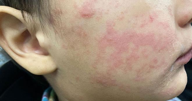 Measles cases surge in FL as summer travel approaches: What to know