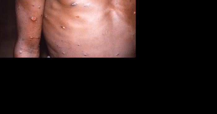Monkeypox infections in FL in double digits, with Broward having the largest number of cases in the state - Vimarsana News