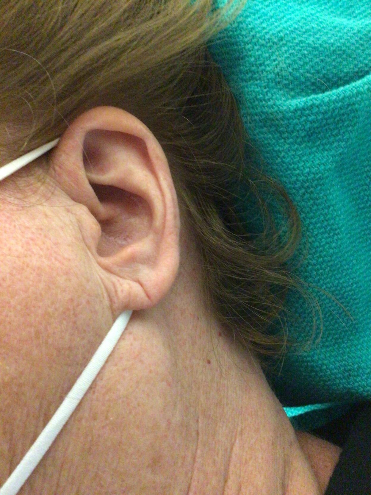 Ear Hole Repair Surgery Cost -