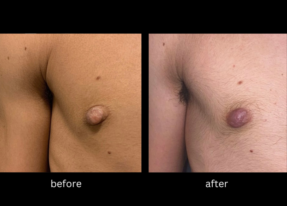 Nipple Reduction, Female & Male Nipple Reduction