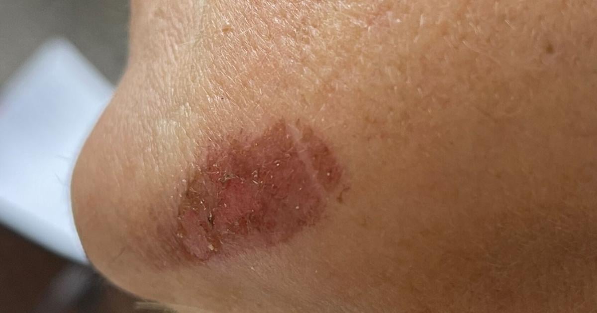 Proper Ointments And Creams Will Help Prevent Scarring From A Burn |  Columnists | Islandernews.com