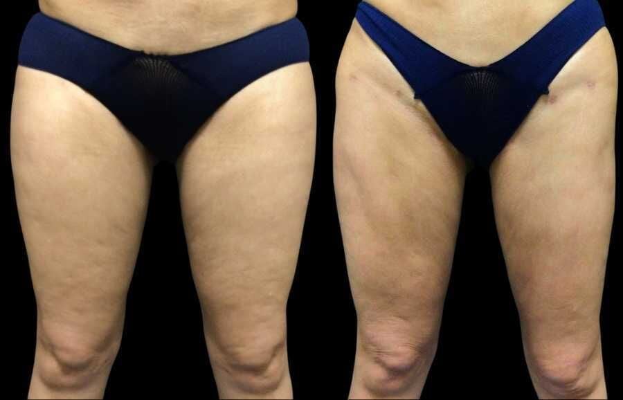 Tired of Excess Body Fat? Why Liposuction Remains a Valuable Solution for  Fat Reduction - Rodgers Center for Plastic Surgery