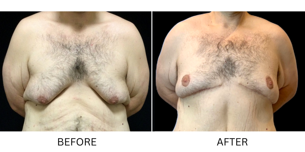 Male breast lift surgery reverses changes after large weight loss