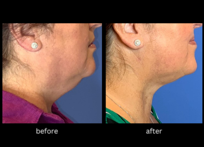 New weight loss drugs changing the spectrum of aesthetic procedures |  Health