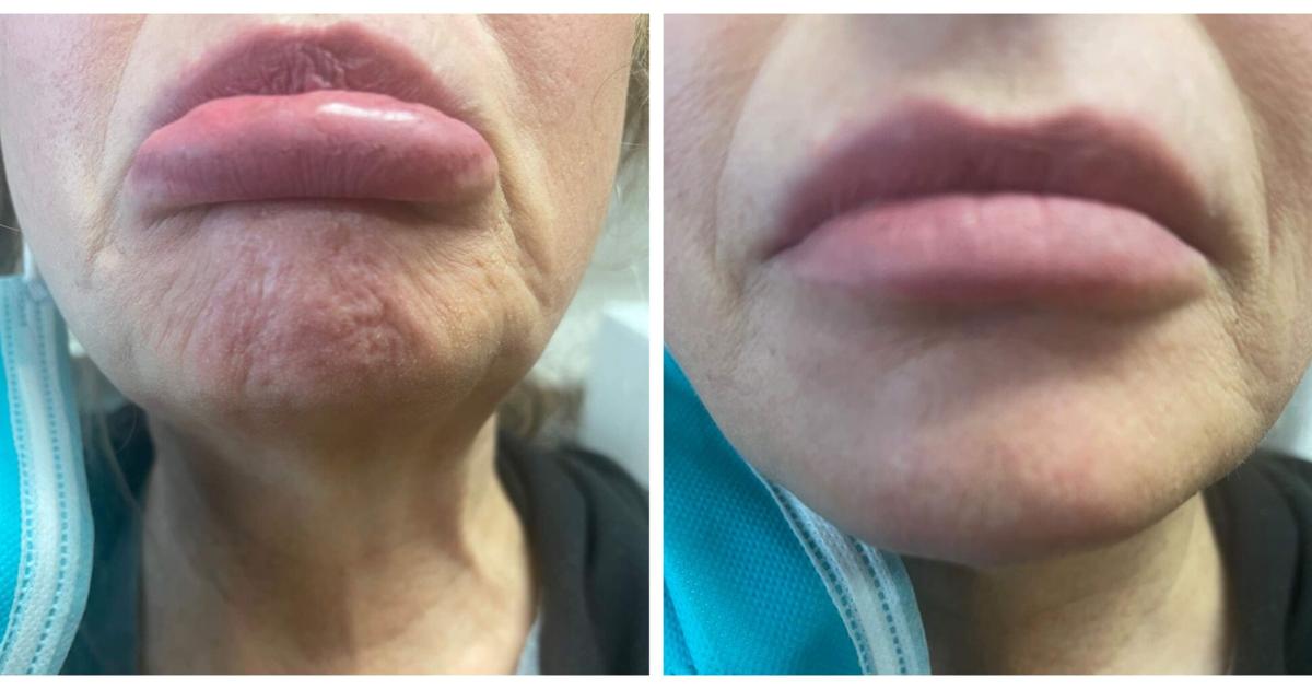 Botox can help improve the look of a dimpled chin | Health ...