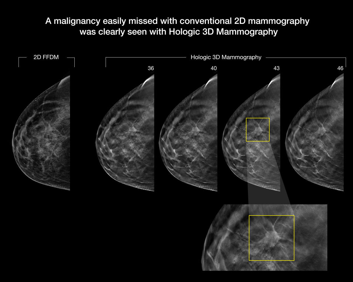 New Tools Improve Mammography | Hole Health | Jhnewsandguide.com