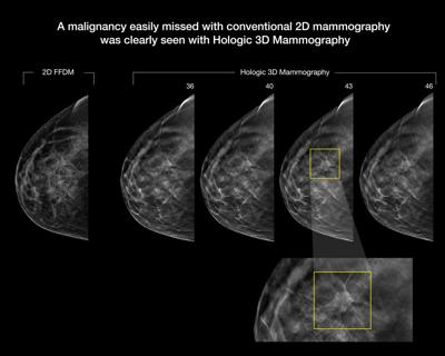 New Tools Improve Mammography Hole Health Jhnewsandguide Com