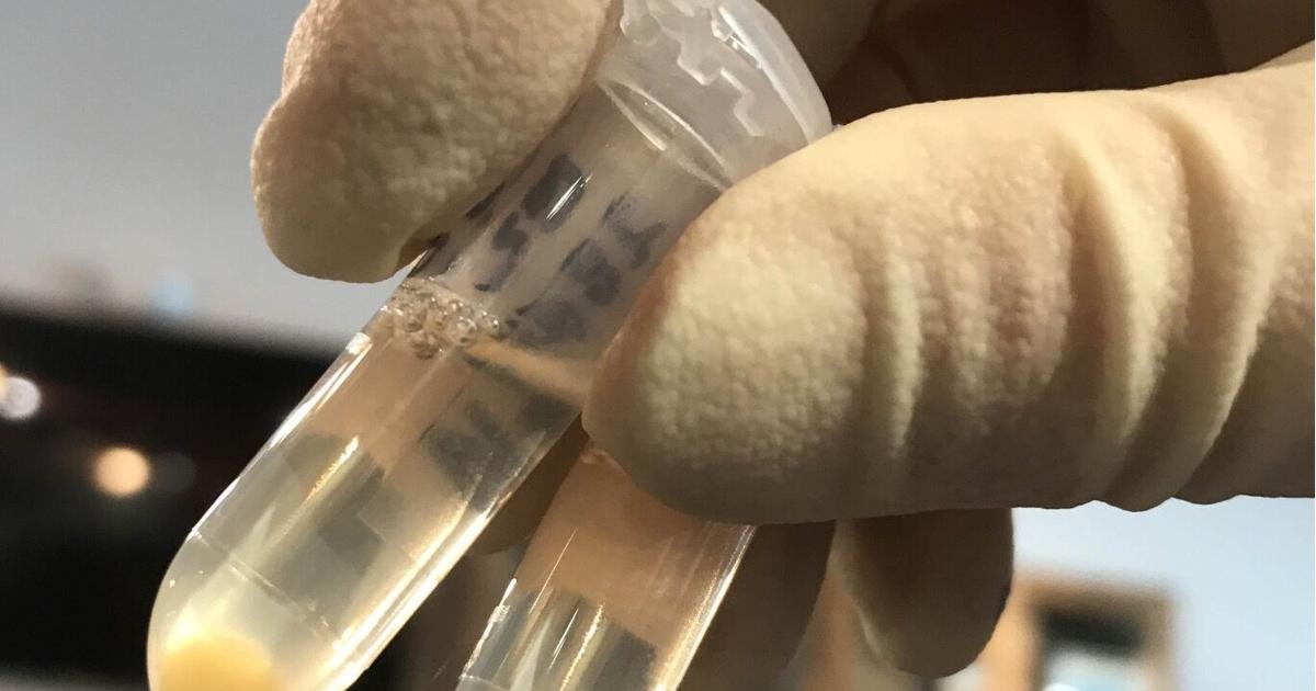 New blood test developed in Jackson lab could help ALS patients | Local ...