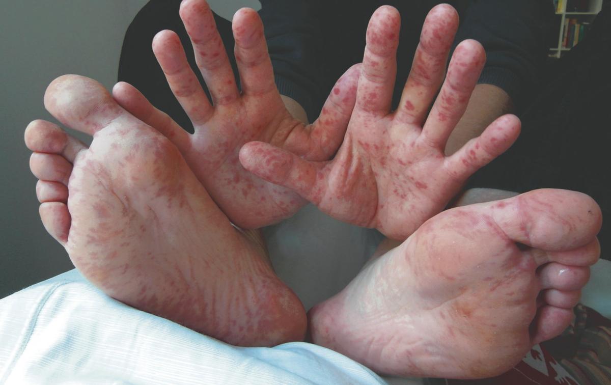 Jefferson County sees increase in cases of handfootandmouth disease Local News journal