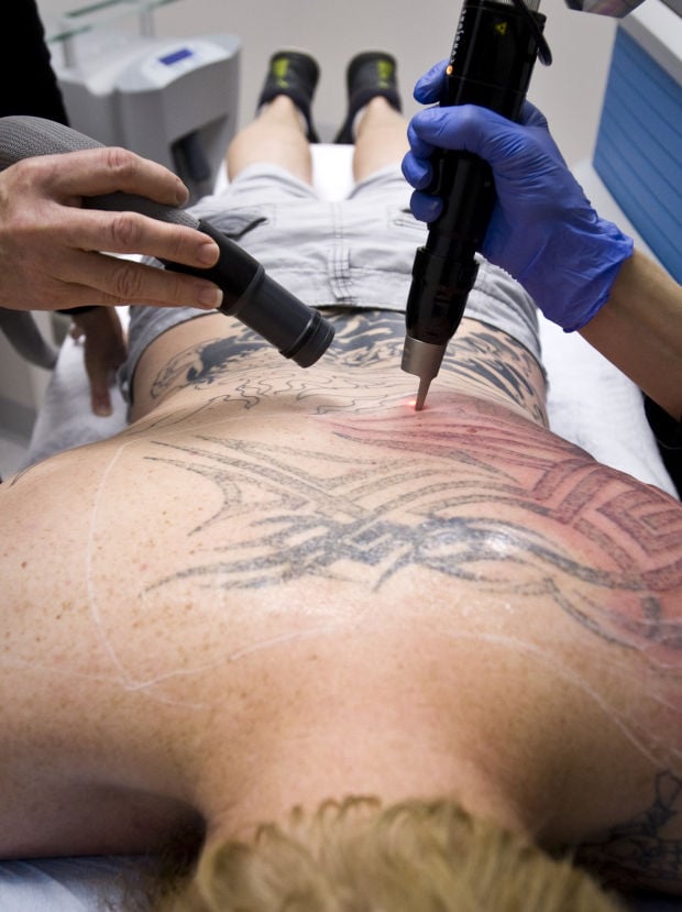 Get Rid of Unwanted Ink with Tattoo Removal - Advanced Aesthetics