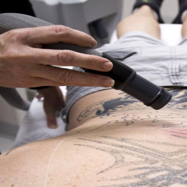 Taking Aim At Unwanted Tattoos Business News Journalnow Com