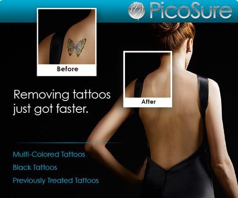 PicoSure Laser Tattoo Removal