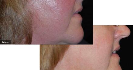 Laser Genesis Treats Skin Imperfections Laser Genesis Treats Skin Imperfections